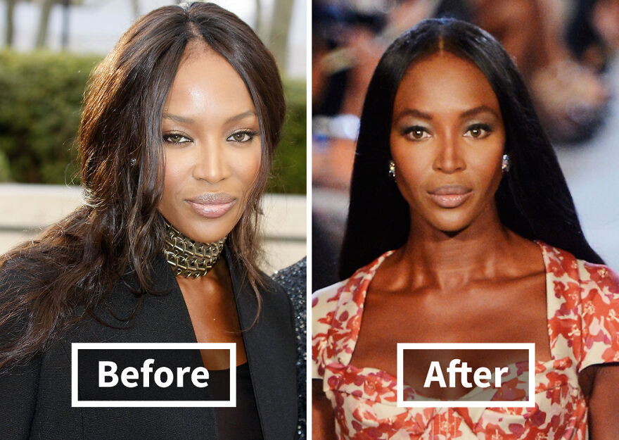 Side-by-side before and after photos of a Naomi Campbell showcasing hair transplant results and transformation.