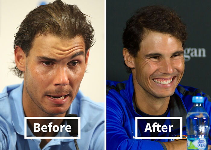 Before and after photos of a celebrity showing noticeable improvement after hair transplants with fuller hair and a bright smile.