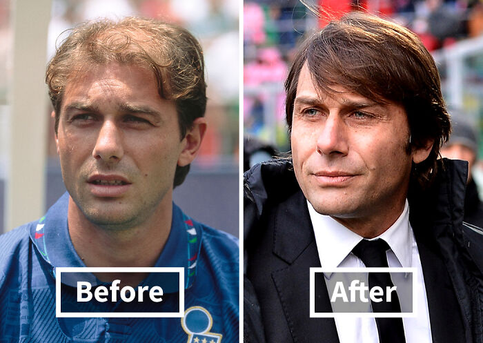 Before and after photos of a man showing noticeable improvement after hair transplants with fuller hair and a confident look.