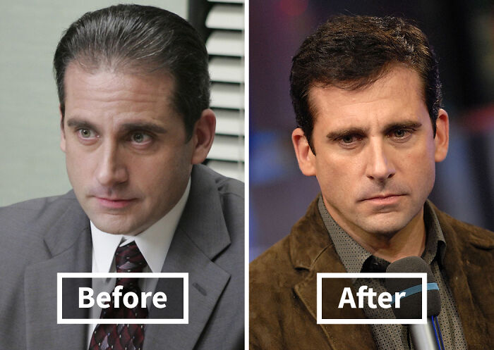 Before and after comparison of a celebrity showing noticeable improvement after hair transplants in a split image.