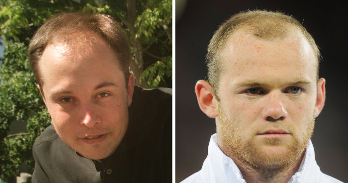 19 Celebrities Who Look Noticeably Better After Hair Transplants