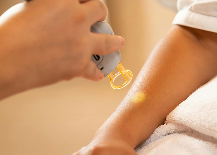 Close-up of laser cosmetic procedure being performed on a person's arm, highlighting cosmetic procedure risks and outcomes.