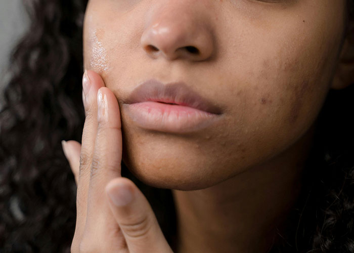 Close-up of a woman with blemishes applying skincare cream, highlighting cosmetic procedure regrets and skin concerns.