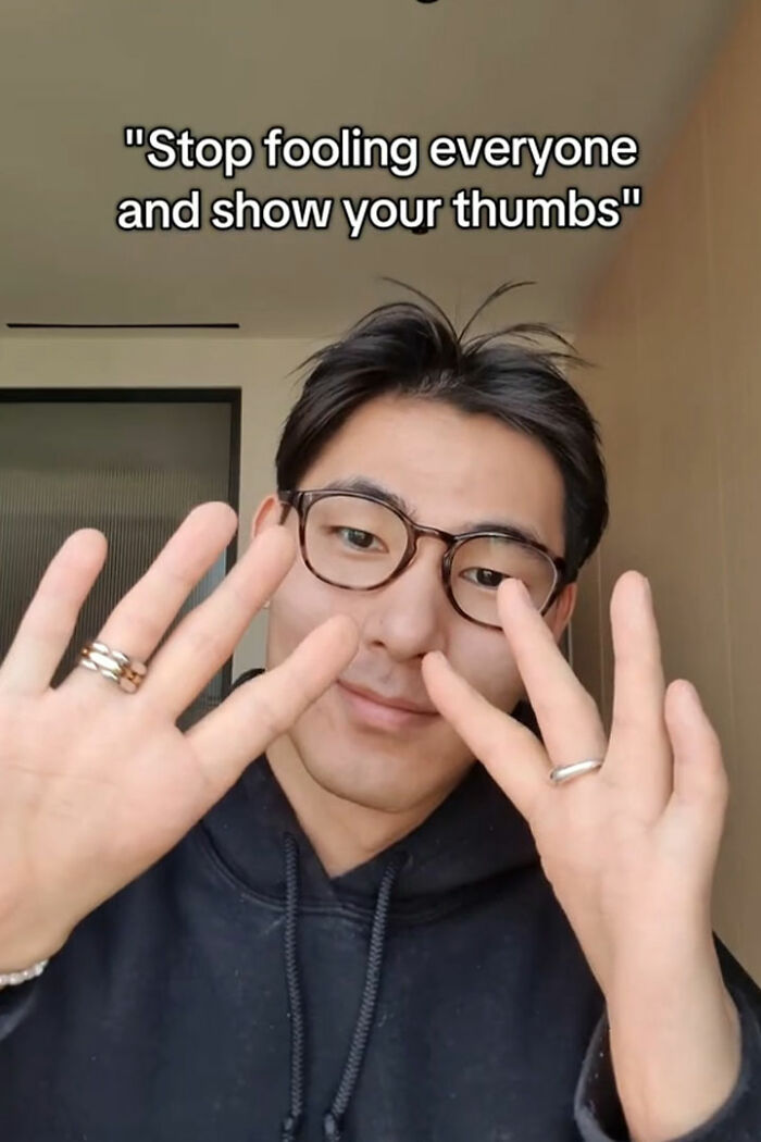 Young man wearing glasses and a black hoodie showing hands without thumbs sharing genius life hacks and quirky humor. Young man wearing glasses and a black hoodie showing hands without thumbs sharing genius life hacks and quirky humor.