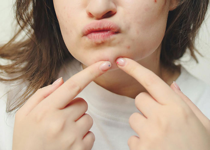 Young woman touching acne on chin, illustrating regret after cosmetic procedure on skin in a close-up photo.