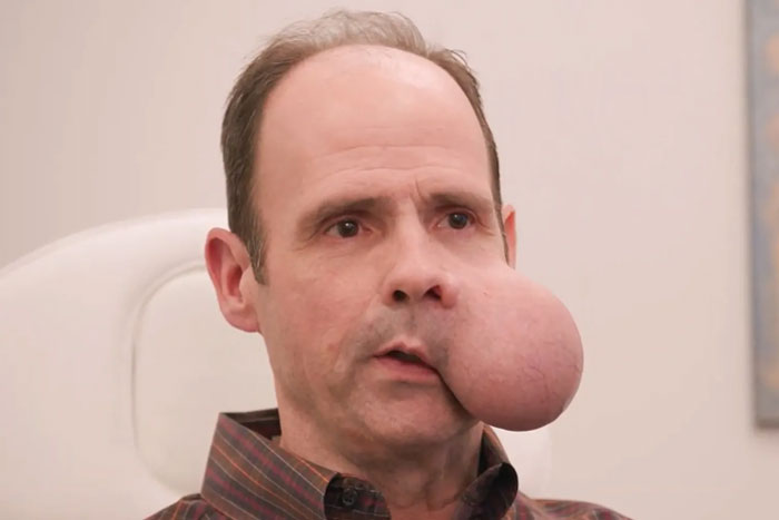 Man with large 4-lb face tumor sitting indoors, seeking urgent medical help as doctor issues fatal warning.