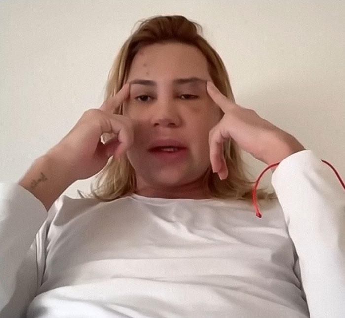 Influencer with visible facial marks discussing complications from popular fox eyes surgery in a casual indoor setting.