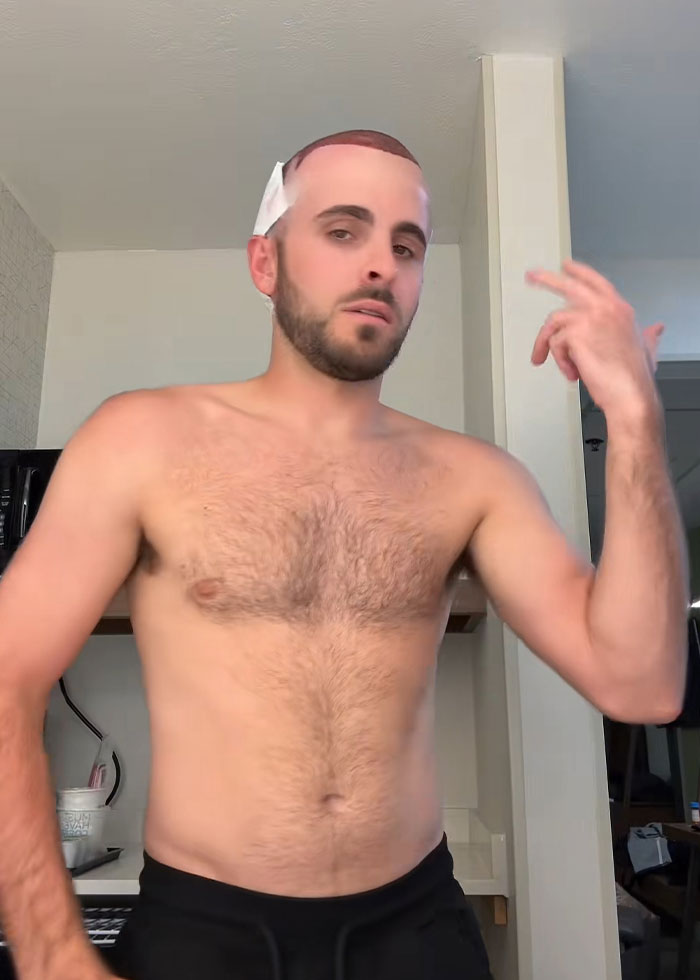 Man showing hair transplant recovery with scalp wrapped in bandages, highlighting hair transplant process and healing stage.