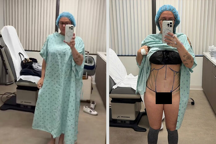 Mom in hospital gown showing before and after transformation highlighting waist ribs broken for smaller waist procedure.