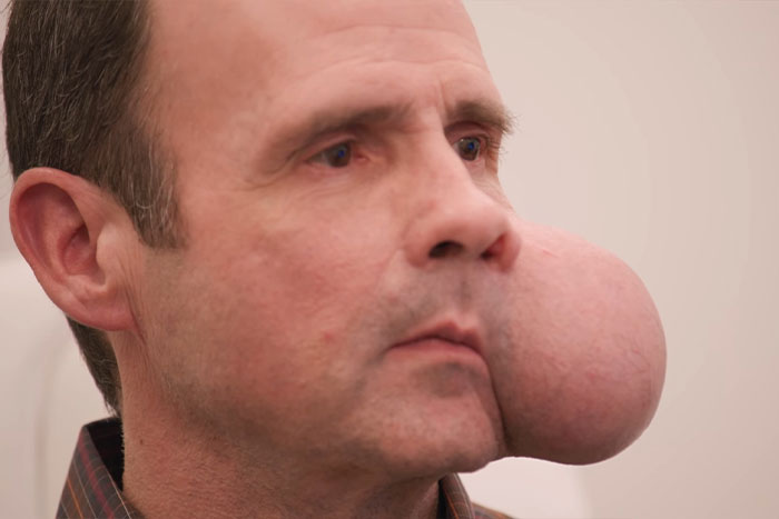 Man with large 4-lb face tumor on cheek urgently seeking medical help amid fatal doctor warning.