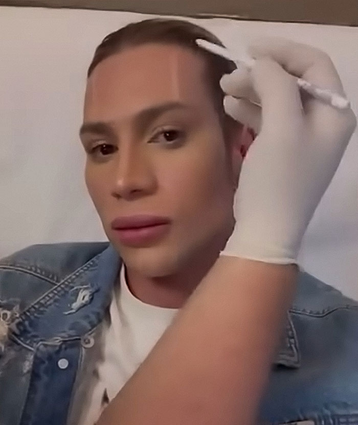 Influencer receiving cosmetic procedure, highlighting risks and complications from popular Fox Eyes surgery trend.