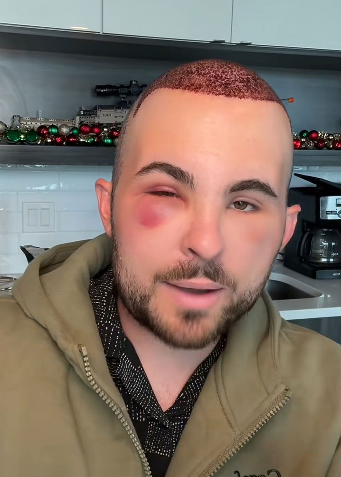 TikToker showing hair transplant recovery with a red, healing scalp and bruised eye, wearing a green hoodie indoors.