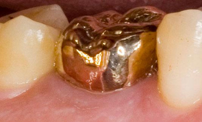 Close-up of a metal dental crown on a molar tooth illustrating an unusual connection to worst crimes in hometowns.