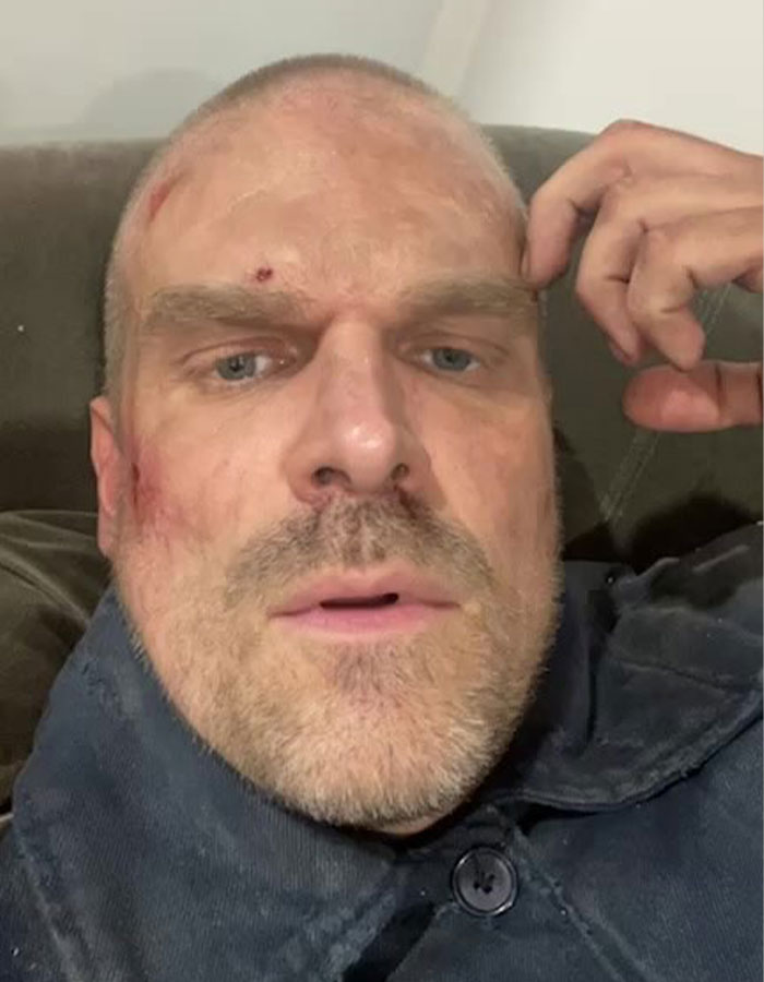 Close-up of David Harbour with visible facial wounds, relating to Lily Allen seemingly revealing shocking details.