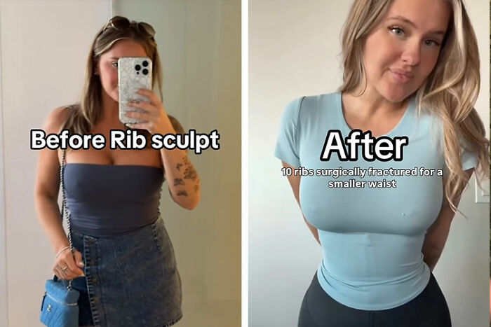 Mom showing before and after transformation of surgically fractured ribs to achieve a smaller waist in side-by-side photos.
