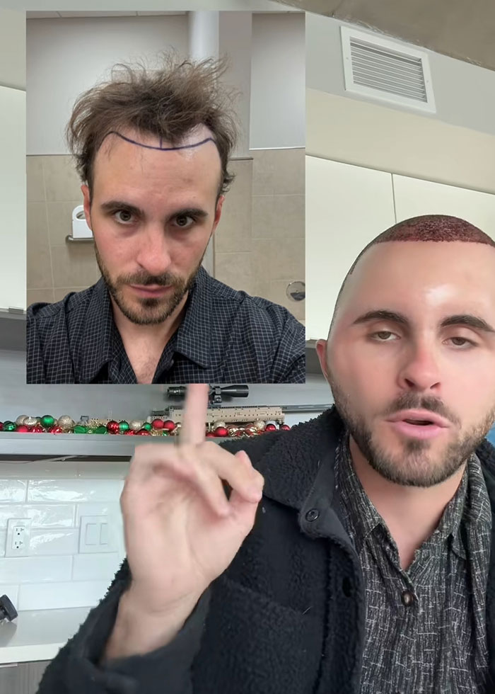 TikToker showing hair transplant recovery stages with visible grafts and marked hairline, sharing experience humorously.