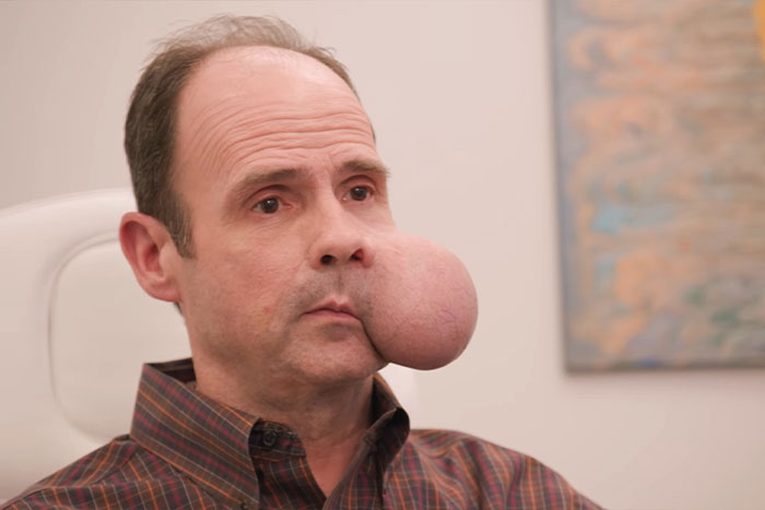 Man with a large 4-lb face tumor sitting indoors seeking urgent medical help amid a fatal doctor warning.