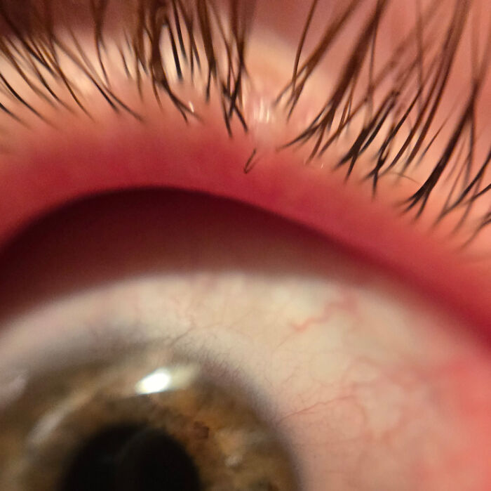 Close-up of an irritated eye with red, inflamed skin and visible eyelashes, showing mildly infuriating discomfort.