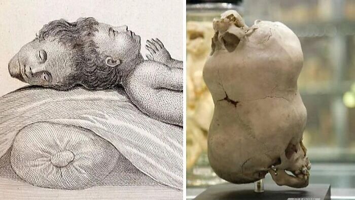 Split image showing a historical illustration and a skull with an unusual shape, related to still remains undiscovered today.
