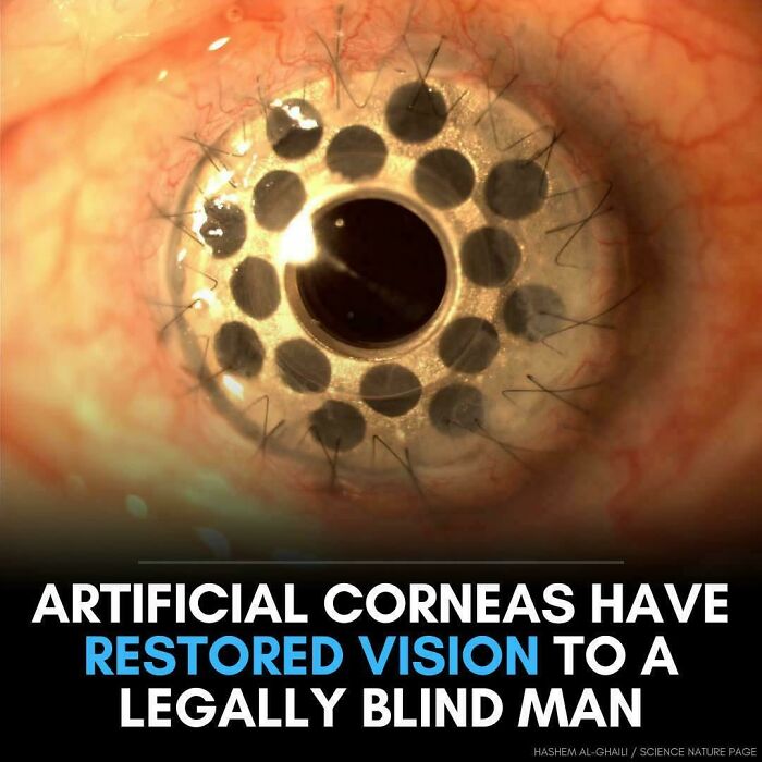 Close-up of an artificial cornea implanted in an eye, showing circular patterns that may trigger trypophobia.