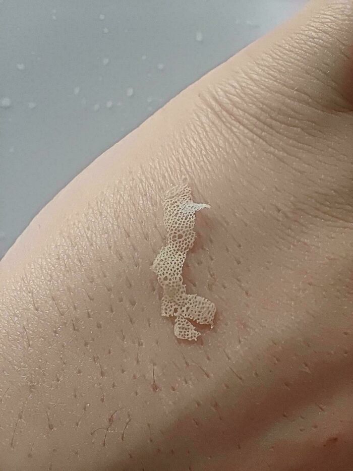 Close-up of peeling skin with a porous texture, evoking trypophobia patterns on human hand surface.