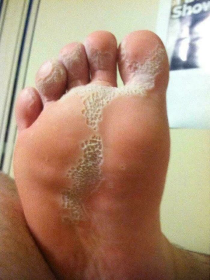 Close-up of a foot with peeling skin and clustered holes, a trypophobia trigger and unsettling visual pattern.