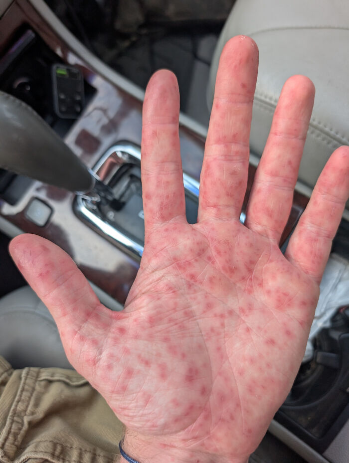 Close-up of a hand covered in red bumps, an unsettling sight triggering trypophobia for sensitive viewers.