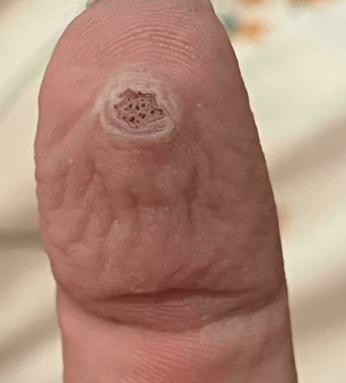 Close-up of a finger tip with textured holes, an unsettling image triggering trypophobia sensations.