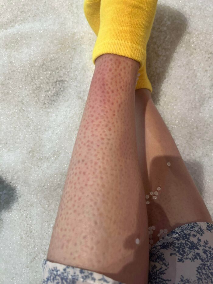 Leg showing red dot pattern on skin, evoking trypophobia reaction, with yellow sock and floral shorts visible.