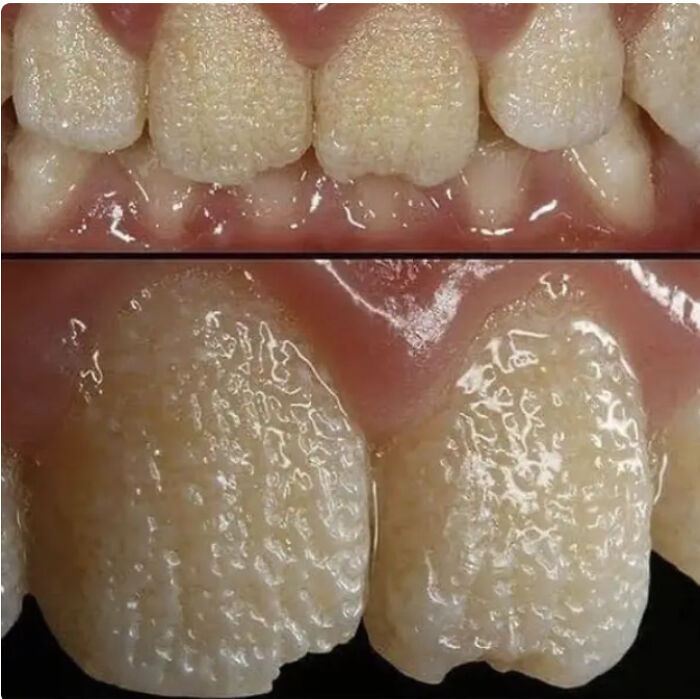 Close-up of textured teeth with bumpy surfaces causing discomfort for people with trypophobia.