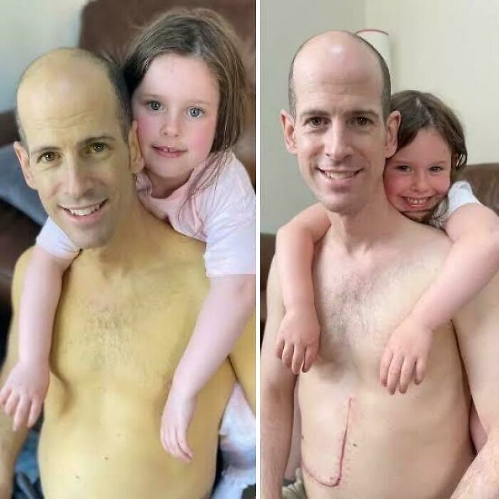 Man with daughter hugging from behind in two photos showing a scar, inspiring fascinating photos and stories to see the world differently