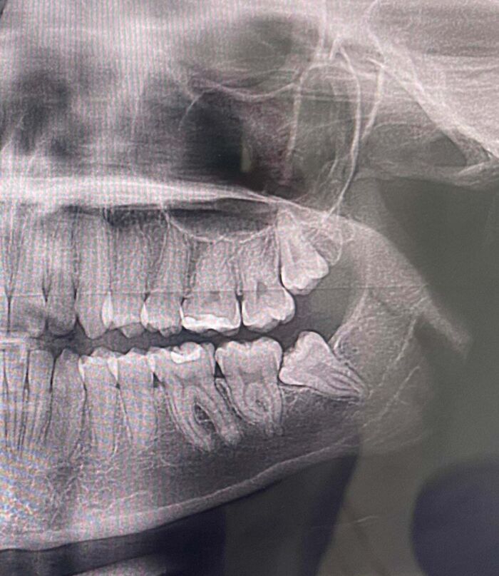 Dental X-ray showing impacted wisdom teeth, highlighting challenges in American healthcare access and treatment realities.