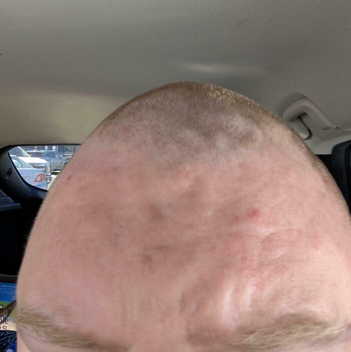 Close-up of a person's forehead with faint marks and blemishes, showing mildly infuriating imperfections testing patience.