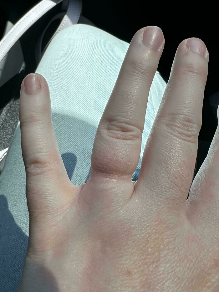 Close-up of a swollen finger on a hand, illustrating an interesting pic that answers questions you didn’t know you needed.