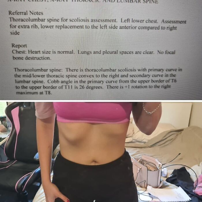 Medical report detailing thoracolumbar scoliosis followed by a photo showing a person's exposed midsection for medical context.