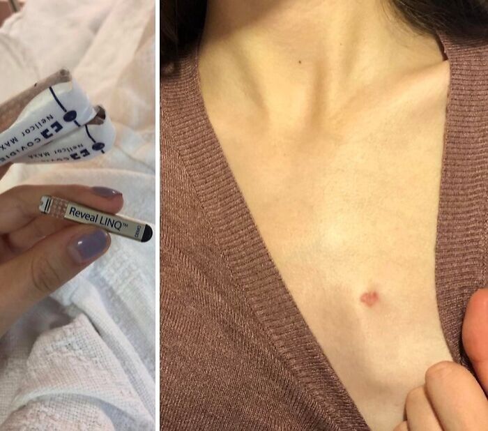 Close-up of a small medical device next to a scar on a person's chest, illustrating fascinating and unsettling medical posts.