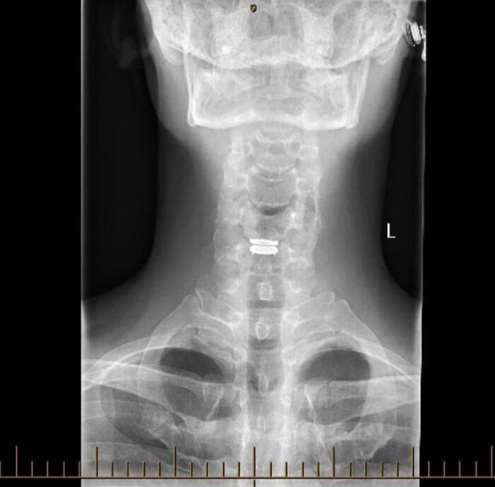 Radiografía de cuello mostrando una anomalía quirúrgica, ilustrando publicaciones médicas bizarras y perturbadoras en línea.