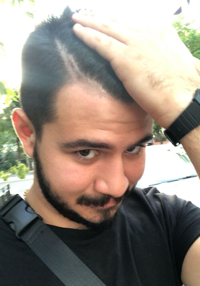 Man showing a hilariously tragic hair accident with an uneven haircut outdoors in casual black shirt.