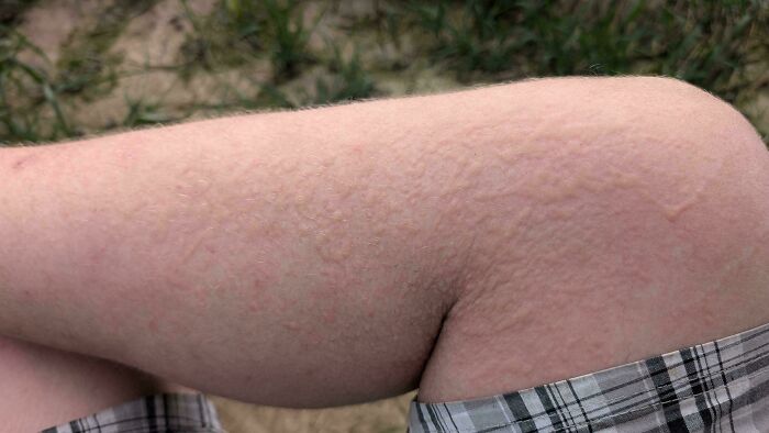 Close-up of a leg with dry, patchy skin and a faint tan line, illustrating a messy skin condition photo.