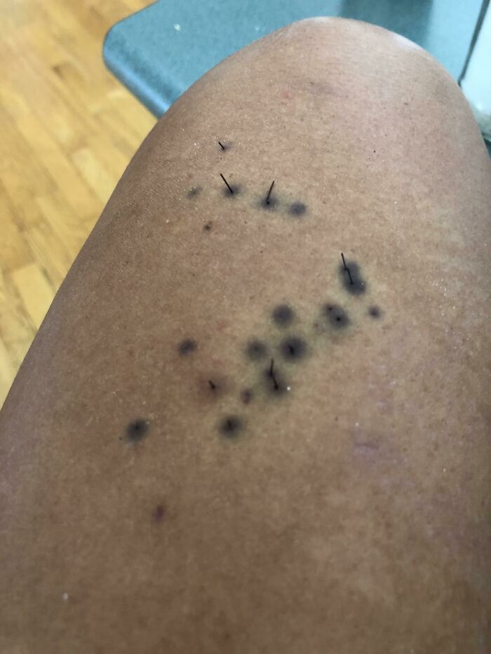 Pierna con múltiples púas clavadas y moretones negros, mostrando una situación que puede empeorar según fotos impactantes.