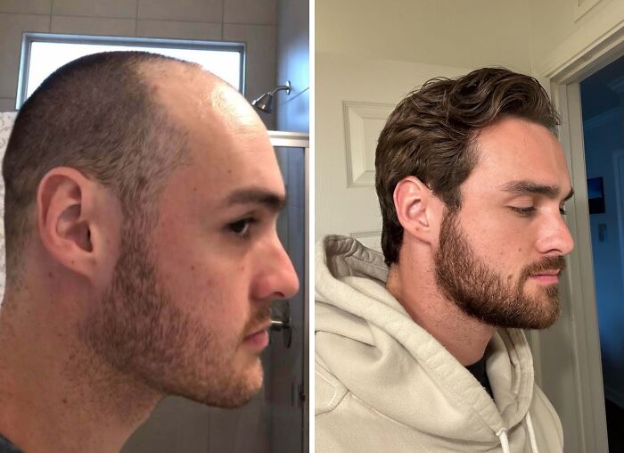 Side-by-side before and after photos showing a man’s hair and beard transformation in stunning before-and-afters.