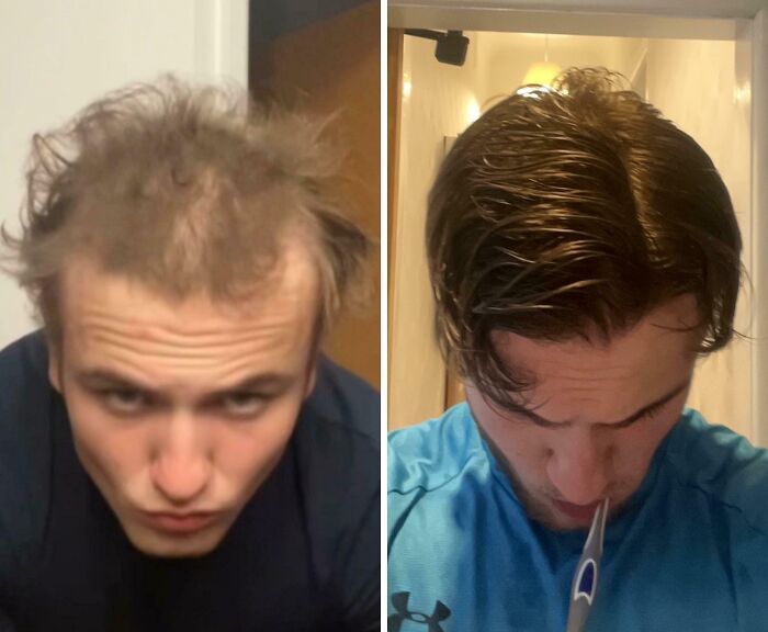 Before-and-after photos of a man showing a hair transformation with fuller, styled hair and improved appearance.