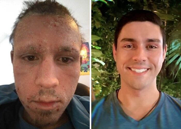 Before-and-after transformation showing a man dramatically reinventing himself with improved skin and confident smile.