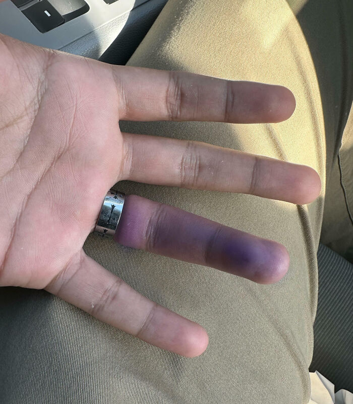 Hand with severely bruised finger wearing a ring, illustrating a total mess and how things can always get worse.