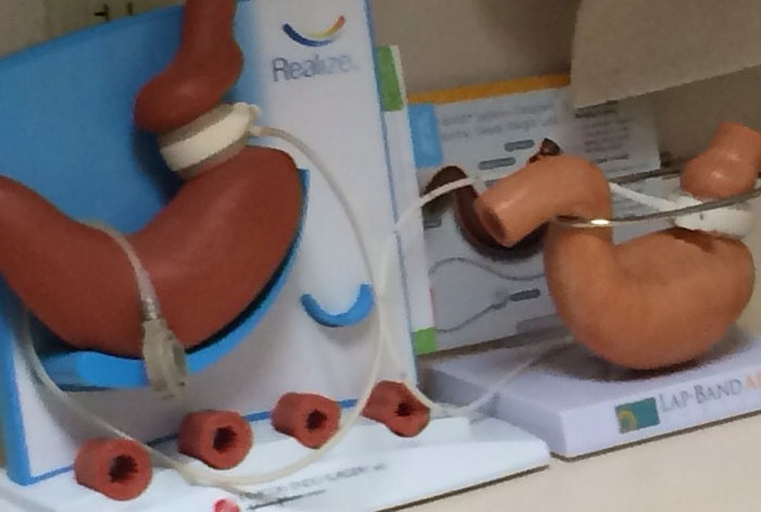 Models of stomachs used by plastic surgeons to demonstrate surgical procedures, highlighting unnecessary surgeries performed.