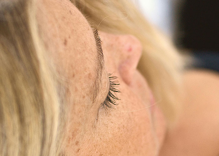Close-up of a woman's freckled face and eyelashes, illustrating natural skin before a cosmetic procedure.
