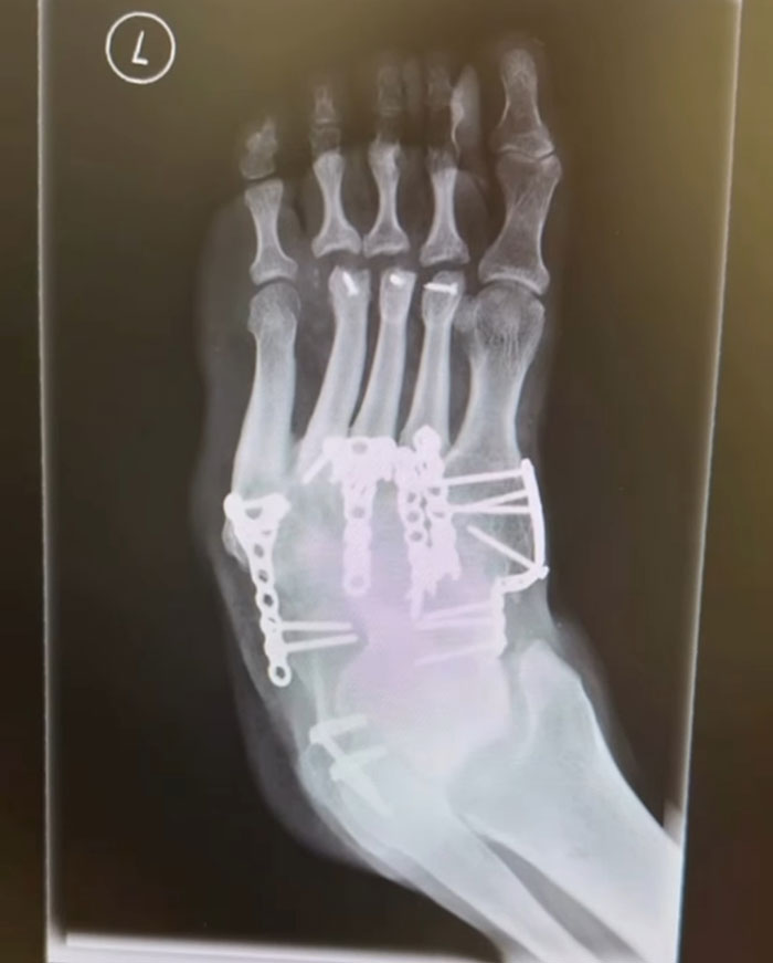 X-ray image of a foot with metal implants showing damage leading to leg amputation after rock concert incident.