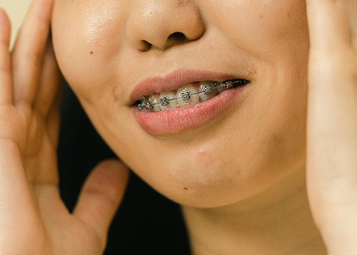 Close-up of a person with braces on teeth, highlighting concerns related to cosmetic procedure regrets.