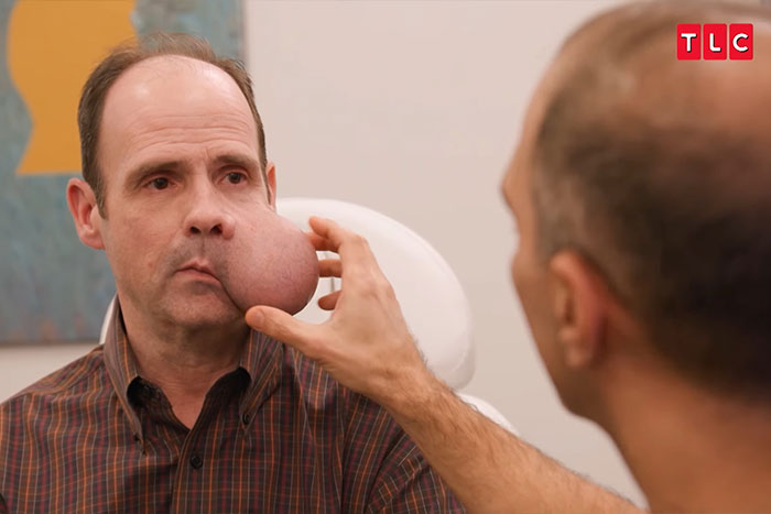 Man with 4-lb face tumor being examined by doctor in medical setting while seeking urgent help for condition.