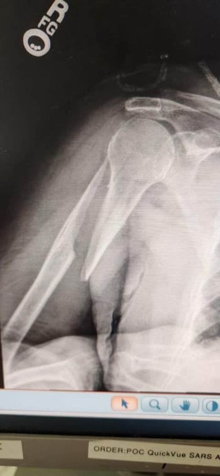 X-ray image showing a fractured humerus bone, a medical post highlighting fascinating and unsettling injuries.